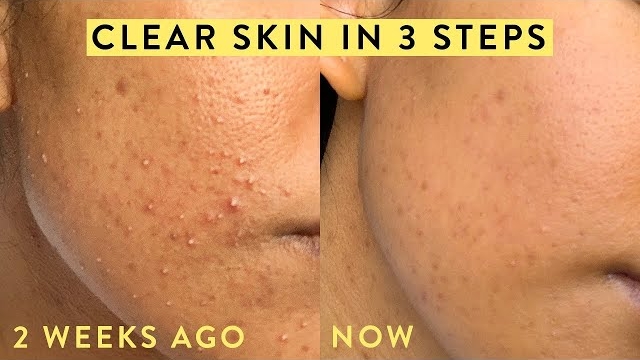 How To Improve Skin Texture Naturally: Simple Steps