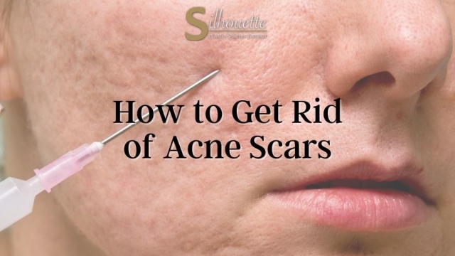 How To Stop Acne Scars From Getting Darker: Fade Fast Tips